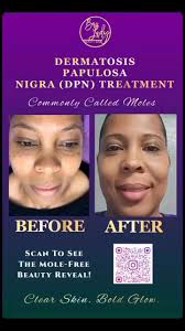 Free Virtual Consultations!, When it comes to DPN, skin tags, and uneven  tone — I don’t just treat skin, I transform confidence. 💜 , Text  CONSULTATION to (757)993-7805 to book your session.