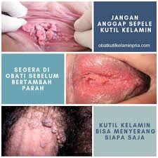 Vesikel mani terletak di bahagian bawah pundi kencing. Ketuat Kemaluan Lelaki Ubat Ketuat Kelamin