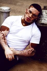 Pin On Vitiligo Skiin