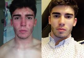 Jauna moteris šešis mėnesius nesiprausė veido ir parodė viską, kas nutiko  jos odai