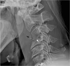 Maybe you would like to learn more about one of these? Cervical Spine Spondylodiscitis Mimicking Teardrop Fracture Sciencedirect