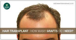 Patient before and after his crown hair restoration with 1500 fue grafts from the scalp.* Hair Transplant How Many Grafts Do I Need