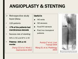 Budd Chiari Syndrome Ppt