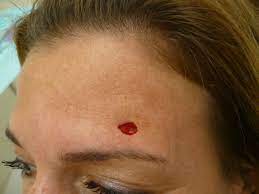 Enter search terms and tap the search button. Pictures Of Skin Cancer Before After Mohs Surgery Jupiter Dermatology Hair Restoration