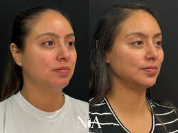 M shaped lips are the hardest to inject! 💉 This #beauty was injected with  1 syringe of #lipfiller to #balance the M shape of her #lips! LOOK AT THE  DIFFERENCE! To balance