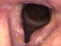 Image result for Chronic Laryngitis