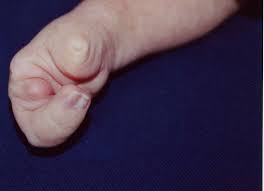 When considering and planning the surgical options, the extent of the chest wall deformity and the degree of muscular involvement. Cleft Hand Article