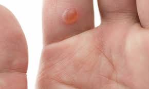 Should I Pop The Blood Blister On My Finger Smart Tips