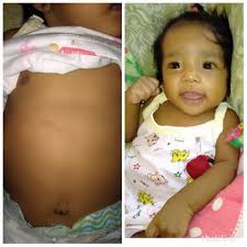 Little Fighter Briana Medical Fundraising Page With Gogetfunding