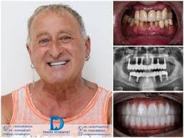 Maybe you would like to learn more about one of these? Clinical Cases Photos Before And After Dental Work Traveltodentist Chisinau Moldova