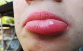 Swollen Lips Causes Home Remedies Medical Treatments Precautions Skinkraft
