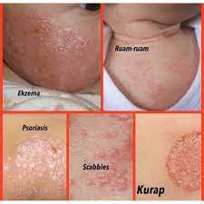 Kesan sisik pada kulit pun dah hilang tanpa kesan. Ubat Kurap Mujarab Ubat Gatal Ekzema Krim Psoriasis Ubat Eczema Krim Herba Shopee Malaysia
