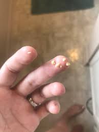 How to remove tonsil stones with finger. Tonsil Stones While Pregnant December 2018 Babies Forums What To Expect