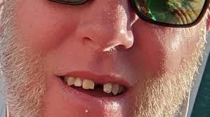 Fundraiser by Brian Beerbower : Front Tooth for BEERBOWER