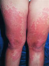 Image result for polymorphous eruption