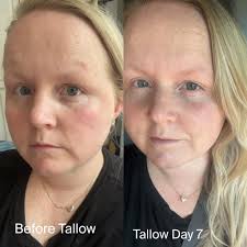 Reducing rosacea redness with skincare product