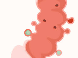 Diverticulitis Diet A List Of Foods To Avoid Diverticulosis is common, doesn't cause symptoms or need treatment. diverticulitis diet a list of foods to
