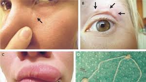 Apa arti kedutan kelopak mata kiri atas menurut primbon jawa, dan bagaimana pejelasannya menurut islam? Cacing Di Kelopak Mata Bergerak Dan Membentuk Benjolan Health Liputan6 Com