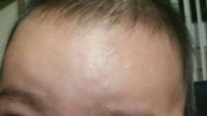 Granitos En La Frente De Mi Bebe Ayuda Bebes De Septiembre 2014 Babycenter