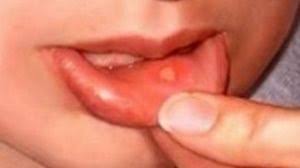 Image result for Aphthasol