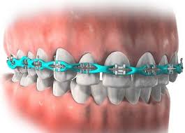 Contact our friendly team for more information on how to get rid of braces pain. A Power Chain Brace Is An O Shaped Elastic Ligature Forming A Continuous Band Between The Teeth The Brace Is Use Dental Braces Power Chain Braces Orthodontics