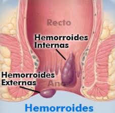 Recomendaciones Para El Paciente Con Hemorroides Instituto Quirurgico De Andalucia Iqa