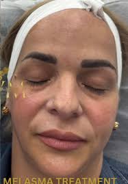 Swipe through this incredible melasma transformation! ✨ Consistency, care,  and the right treatment make all the difference. 📆 Book Now! ☎  (786)953-4111 📍 4355 W 16th Ave Suite 205B Hialeah, FL 33012 ...