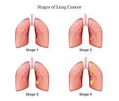 Lung Cancer | Symptoms, Causes, Treatment And Survival Rates