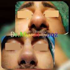 It is associated with respiratory problems like common cold, asthma, whooping cough, etc. How To Reduce Thick Skin On Nose