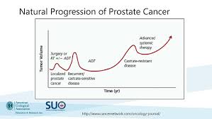 Image result for Prostate Cancer Management