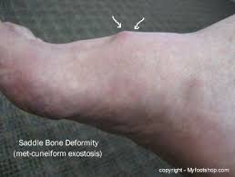 Pin On Foot Conditions