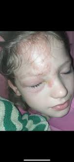 Please treat me for sunburn. Ramona ann Hebert