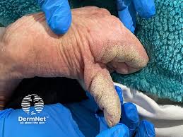 Image result for scabies on genitals