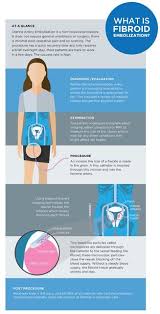 Patients should be informed that if morcellation is used, there is a very small risk of disseminating cancerous cells. What Are Uterine Fibroids And How Do You Treat Them St Clair Health