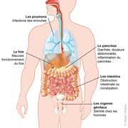 Il n'existe pas de traitements curatifs. C Est Quoi La Mucoviscidose Medipedia