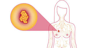 When malignant cancer cells form and grow within a person's breast tissue, breast cancer occurs. Breast Cancer Facts National Breast Cancer Foundation