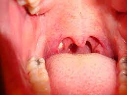 White spots on throat or the tonsils are often seen as an indication of an infection. Pictures Of White Bumps In The Throat Youmemindbody