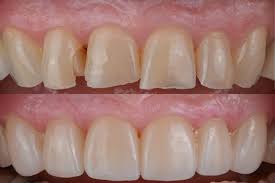 Smile Makeover With Porcelain Versus Composite Veneers - Hemet Dental  Center: Brian Stiewel DDS, INC. Hemet California