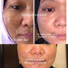 Terlebih noda hitam bekas jerawat yang susah hilang. Masalah Jeragat Cara Hilangkan Jeragat Di Muka