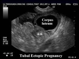 Image result for corpus luteum sonography)