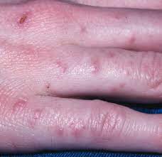 Whether or not you experience an adverse reaction from leaving. Cactus Dermatitis