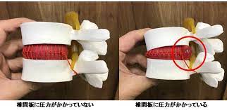 椎間板ヘルニアはカイロプラクティックで治るの？｜神田駅の整体「1upカイロプラクティック」