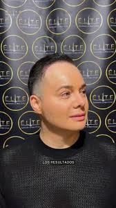 Volvió la seguridad, volvió el cabello., Después de meses luchando con la  caída, decidió confiar en los expertos de Élite… y los resultados hablan  por sí solos., ¡Injerto capilar exitoso y natural!, ...