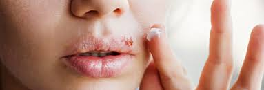 It results in the formation of painful blisters or sores on the skin, typically around the mouth or genitals. Herpes Treating Cold Sores And Other Symptoms Dermatology Mohs