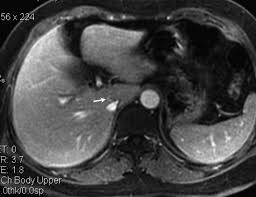 Hepatic Caudate Vein In Budd Chiari Syndrome Depiction By Using Magnetic Resonance Imaging European Journal Of Radiology