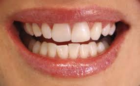 How To Remove Tartar From Teeth Teeth Straightening Teeth Crooked Teeth