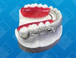 #inman aligner used for correction of teeth, from canine to canine. Inman Aligner Sml