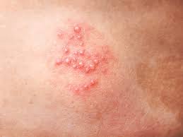 Image result for shingles