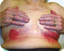 Image result for Candidiasis under breasts