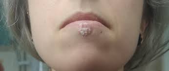 What you eat, stress, etc can have a huge effect on acne (and of course, may other things). Popping Reddit All You Need To Know Including Cure Naija Super Fans